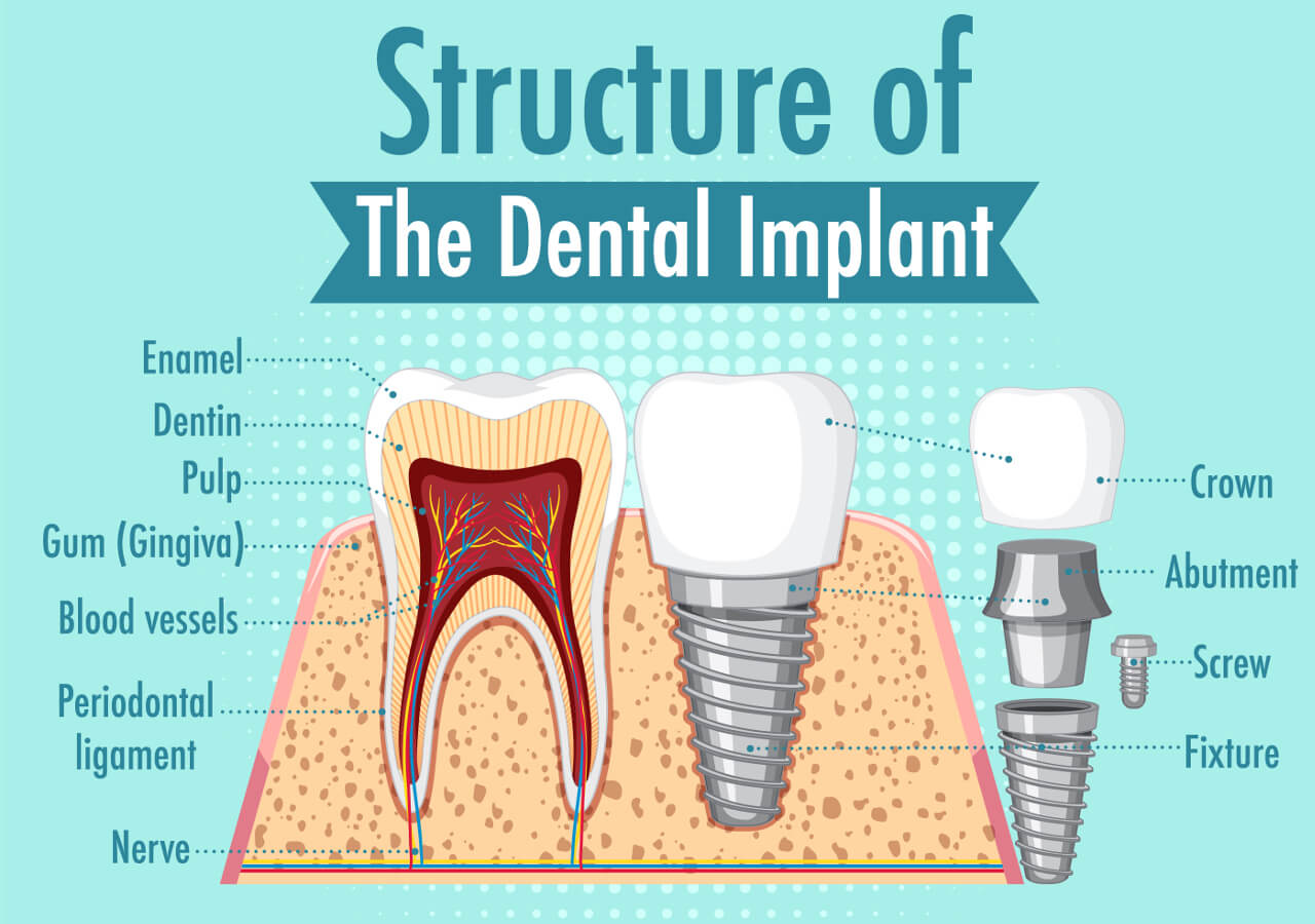 fogászati implantátum felépítése illusztráció