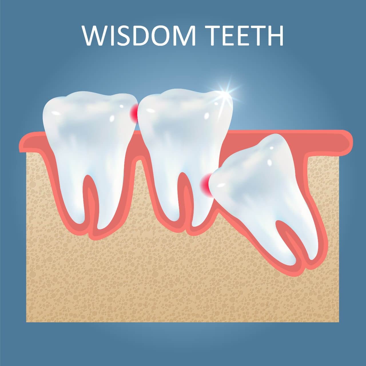 wisdom tooth illustration