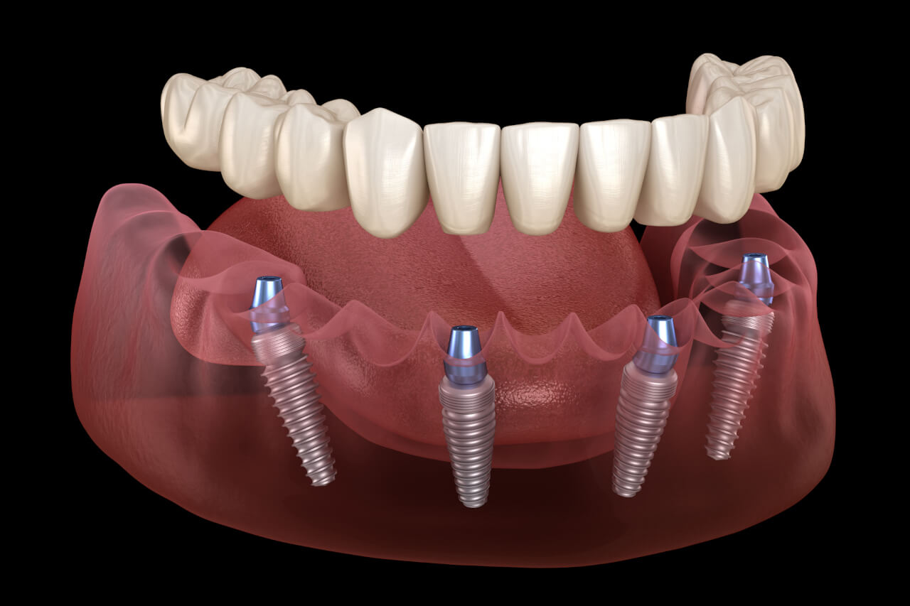 implantatgetragener Zahnersatz